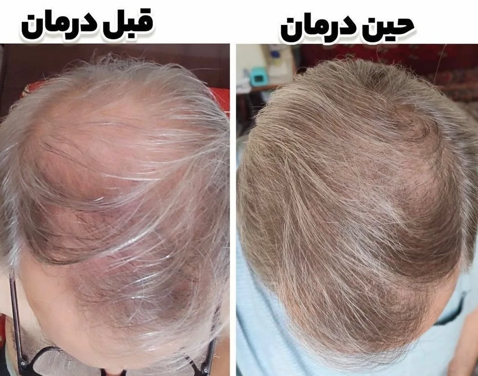 دوره درمانی اقتصادی مخصوص موهای معمولی